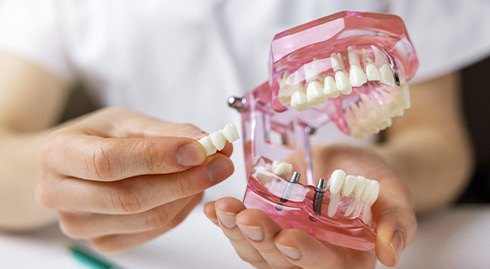 Dentist showing patient model of implant bridge
