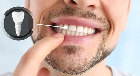 Man pointing to front tooth that’s indicated as dental implant