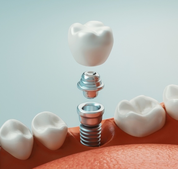 Illustrated model of a dental implant in Raleigh