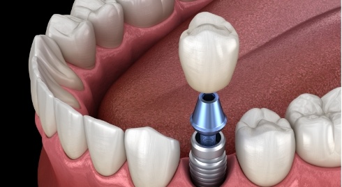 Illustrated dental crown being placed onto a dental implant