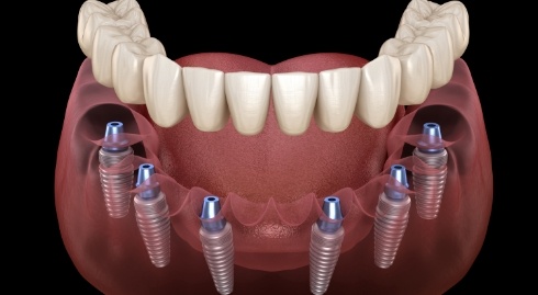 Illustrated denture being placed onto six dental implants