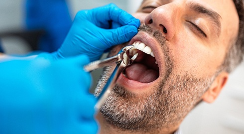 A dentist performing a tooth extraction on a bearded man