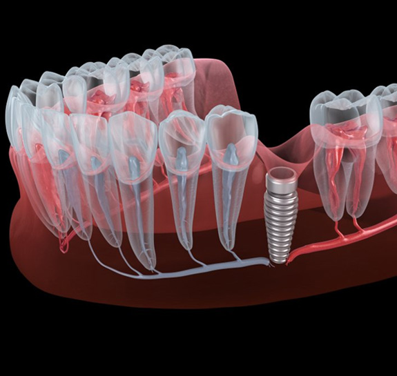 Illustration of dental implant without restoration