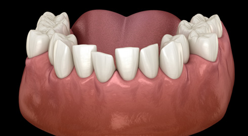 Illustration of crowded teeth