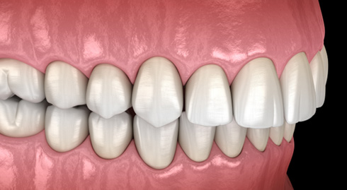 Illustration of an overbite