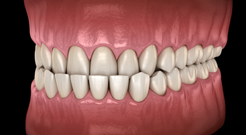 Illustration of an underbite