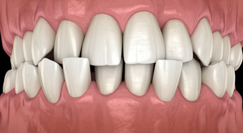 Illustration of an crossbite