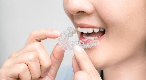 Closeup of patient putting on clear aligner