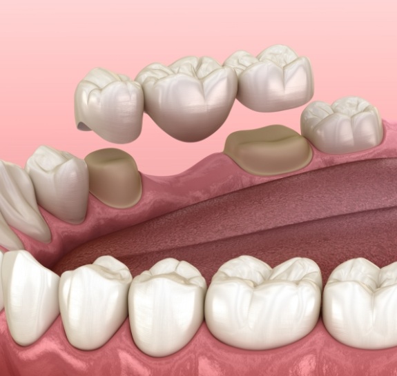 Illustrated dental bridge replacing a missing tooth