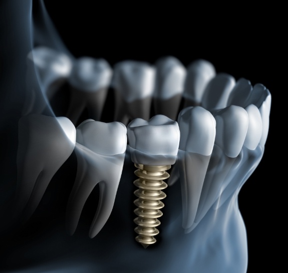 Illustrated X ray of a person with a dental implant replacing a missing tooth