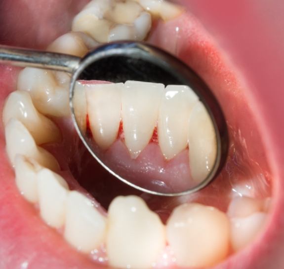 Close up of dental mirror inside of mouth