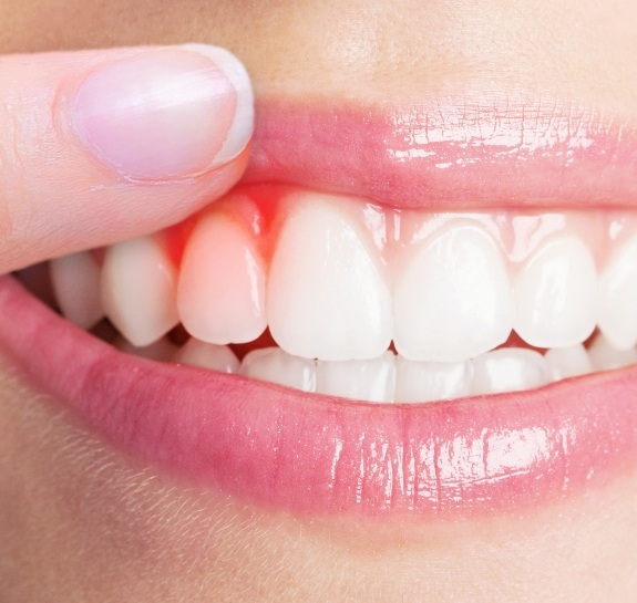 Close up of person pointing to red spot in their gums