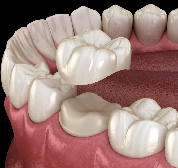 Illustrated dental crown being fitted over a tooth