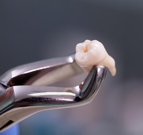 Dental forceps holding an extracted tooth