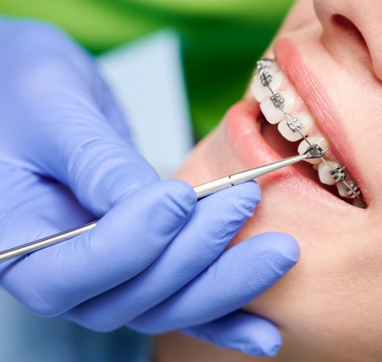 Nose-to-chin view of blue-gloved hand placing band on patient’s braces