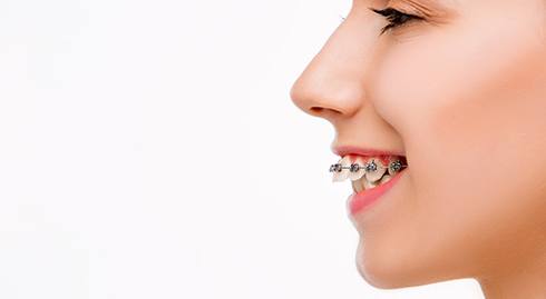 Profile nose-to-chin view of woman’s overbite with braces