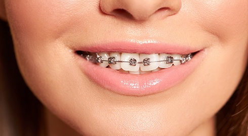 Nose-to-chin closeup of woman’s crooked teeth with braces