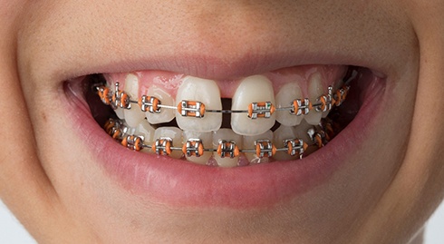 Closeup of someone’s gapped teeth with braces and orange bands