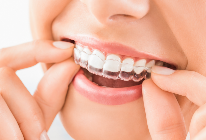 Woman putting on clear aligner