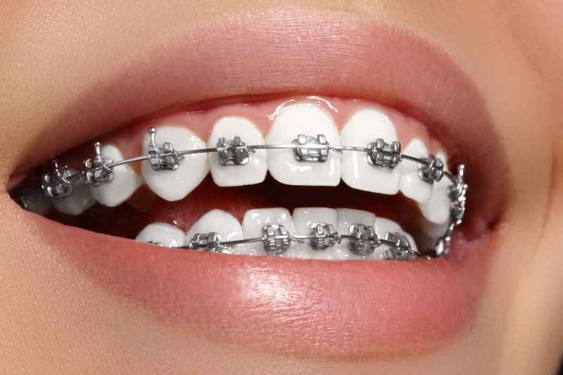 A closeup of a woman’s smile with metal braces