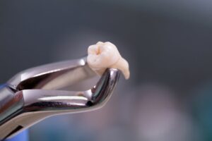 Dentist pulling a tooth